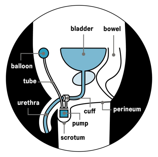 Artificial urinary sphincter