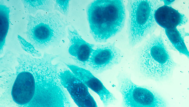 Prostate Cancer Cell Research Adobestock 111509561 PC 3