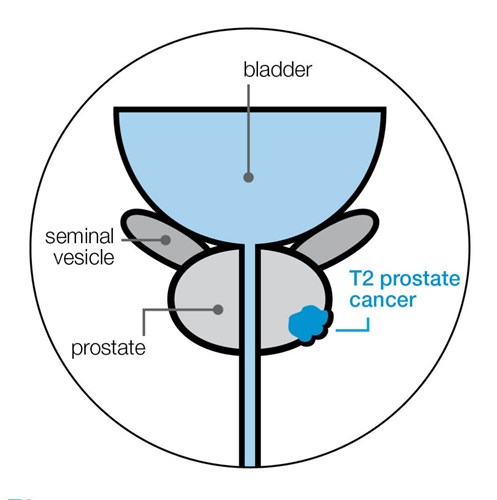 Diagram showing T2 prostate cancer