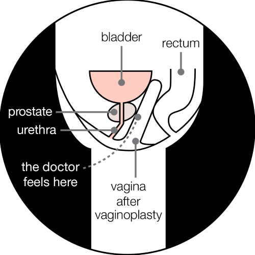 A diagram showing a cross section of the pelvis from the side. The prostate sits under the bladder and in front of the vagina created by the vaginoplasty. The diagram shows that the doctor can feel the prostate through the vagina.