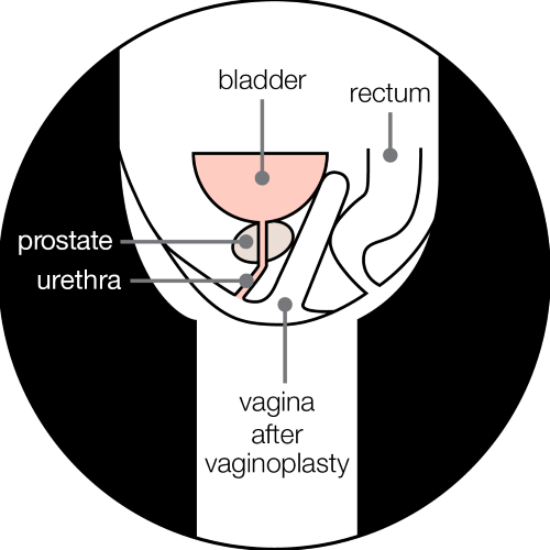 A diagram showing a cross section of the pelvis from the side. The prostate sits under the bladder and in front of the vagina created by the vaginoplasty. Behind the vagina is the rectum.