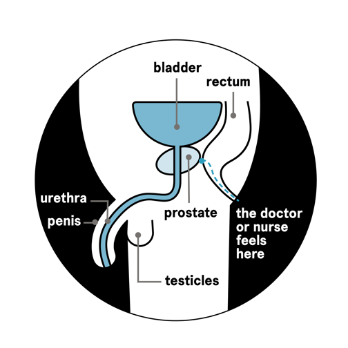 A diagram showing where the doctor or nurse will perform a DRE
