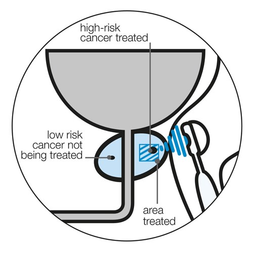 Diagram showing focal HIFU treatment on a single area of cancer in a prostate, with low-risk cancer areas not being treated