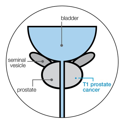 Diagram showing T1 prostate cancer