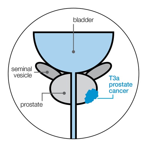 Diagram showing T3a prostate cancer