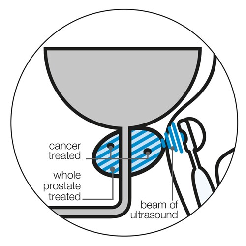 Diagram showing whole-prostate HIFU treating the whole of a prostate