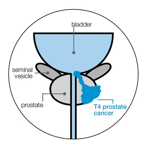 Diagram showing T4 prostate cancer