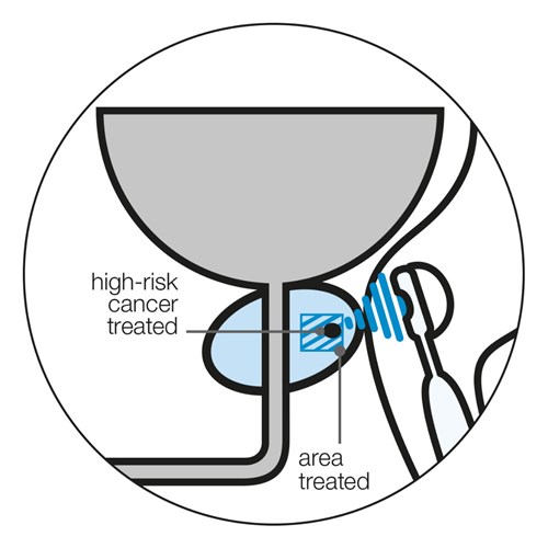 Diagram showing focal HIFU treating a single high-risk area of cancer in a prostate